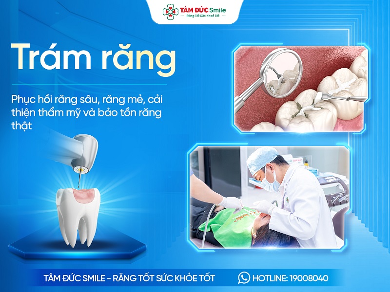 Trám răng là gì? Chi phí, Lợi ích, Quy trình và Địa chỉ uy tín