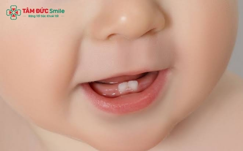 Giai đoạn mọc răng sữa giúp cha mẹ theo dõi quá trình phát triển của trẻ từ 6 tháng đến 3 tuổi.