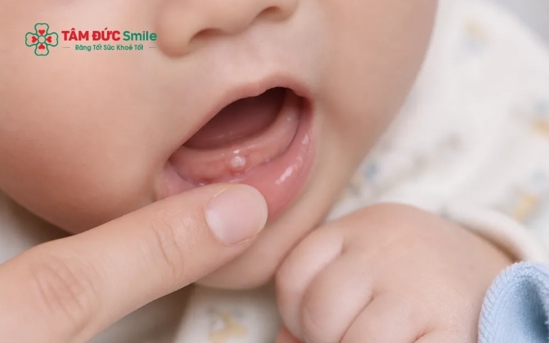 Trẻ thường có dấu hiệu ngứa nướu, chảy nhiều nước dãi và thích cắn đồ vật khi những chiếc răng đầu tiên bắt đầu nhú lên.