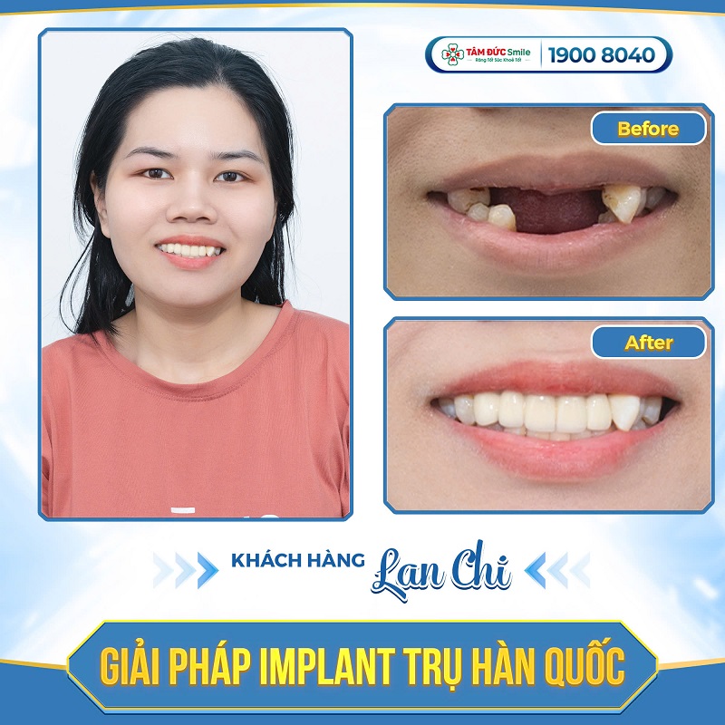 Hàng ngàn khách hàng đã tự tin hơn với nụ cười sau khi trồng răng Implant tại Nha khoa Tâm Đức Smile – Nơi đặt Y đức lên hàng đầu.