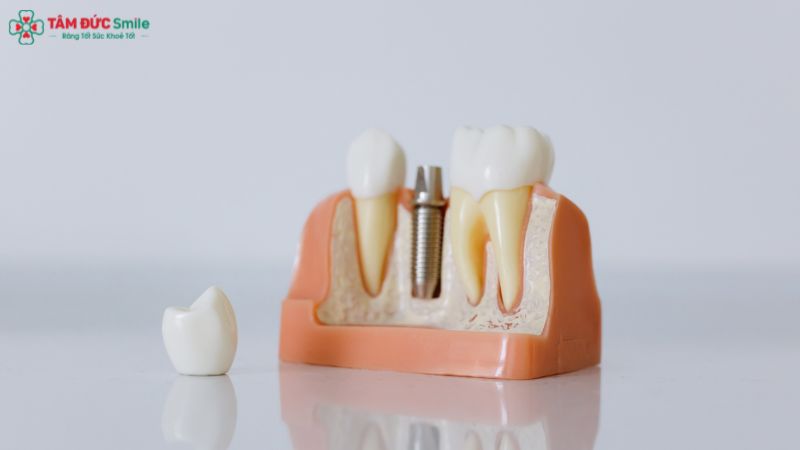 Cấu tạo trụ Implant titan giúp tích hợp xương hoàn hảo – giải pháp phục hồi răng hiện đại nhất hiện nay.