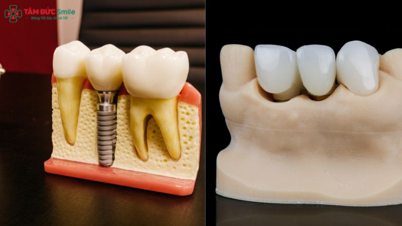 So sánh trồng răng Implant và cầu răng sứ – Implant vượt trội về độ bền, thẩm mỹ và ngăn tiêu xương.
