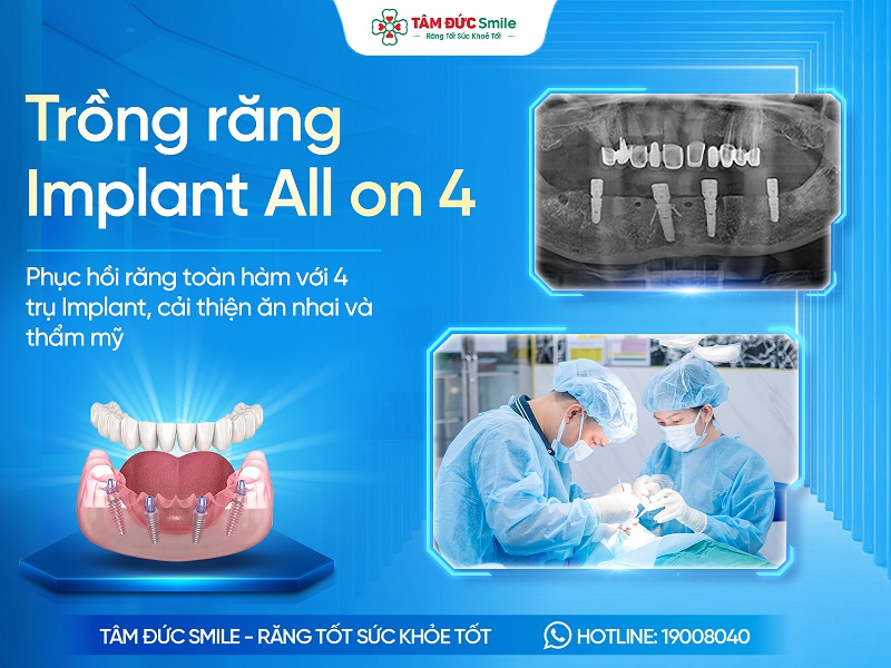 Trồng răng Implant All on 4: Giải pháp cho người mất răng toàn hàm