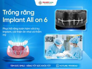 Trồng răng Implant All on 6: Giải pháp cho người mất răng toàn hàm
