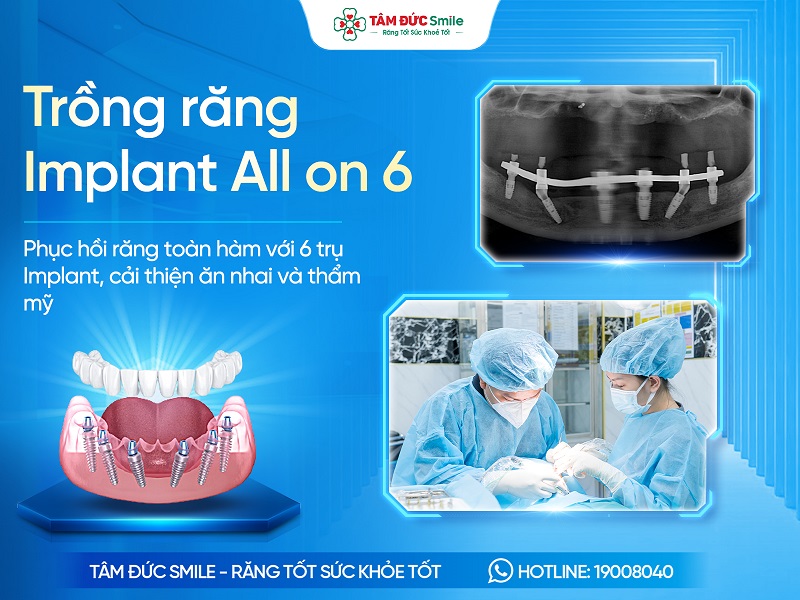 Trồng răng Implant All on 6: Giải pháp cho người mất răng toàn hàm