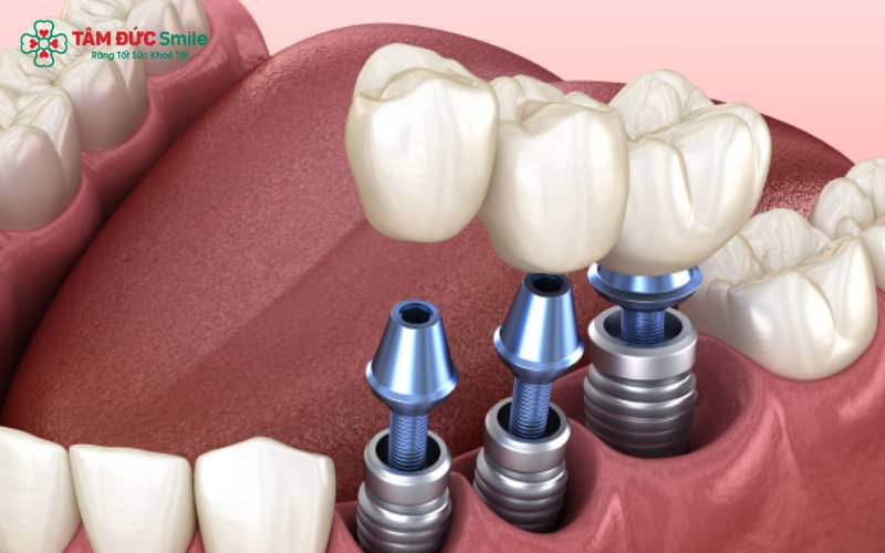 Trong trồng răng implant, gây mê chỉ được chỉ định khi cần thiết, tùy vào đặc thù của từng ca