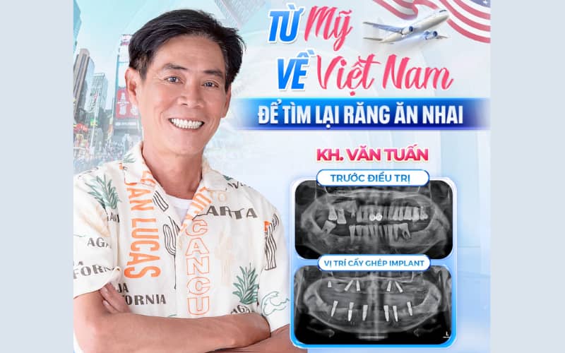 Việc gây mê mang lại cảm giác thoải mái, giúp loại bỏ đau nhức cũng như sự lo âu khi trồng răng implant