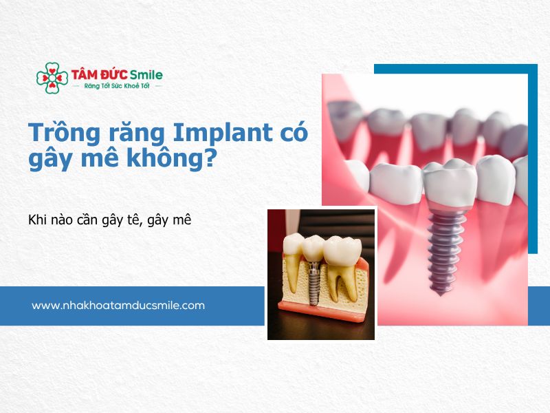 trong-rang-implant-co-gay-me-khong-5
