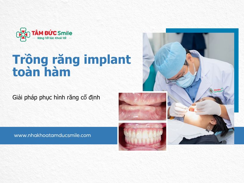 trong-rang-implant-toan-ham-6