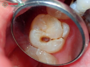 Cách chữa sâu răng hàm tại nhà có hiệu quả không?