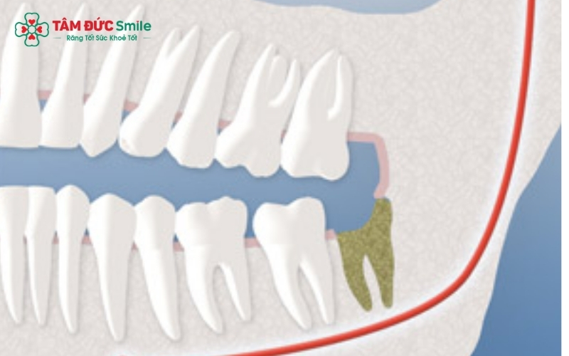 Nếu cơn đau kéo dài quá 3-7 ngày hoặc kèm theo sưng má, sốt, bạn cần đến nha khoa để được kiểm tra kịp thời.