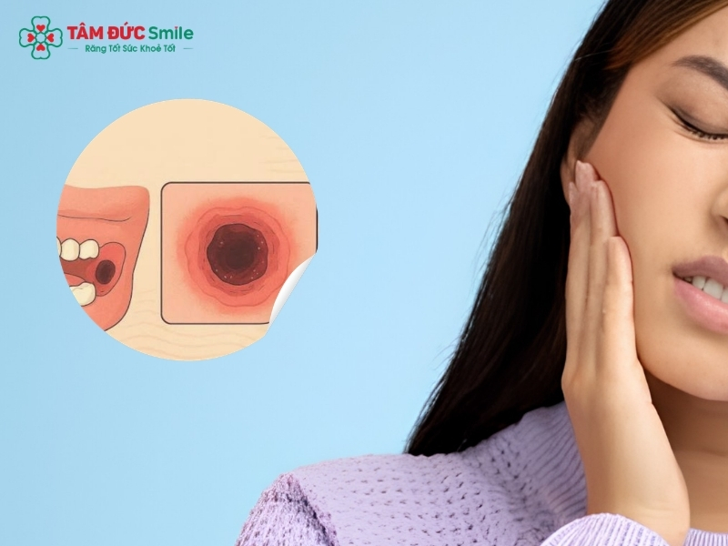 Cách giảm đau khi mọc răng khôn an toàn, hiệu quả