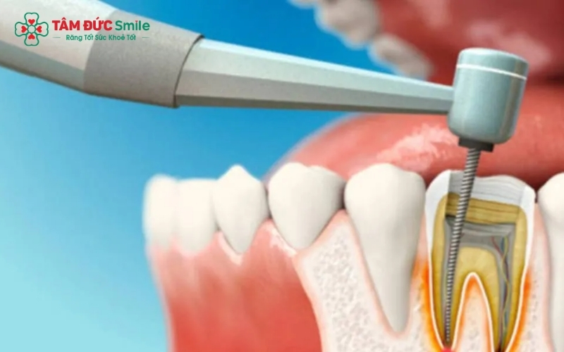 Tại Nha khoa Tâm Đức Smile, bác sĩ ưu tiên các biện pháp bảo tồn như điều trị tuỷ hoặc trám răng, giúp trẻ chấm dứt cơn đau và giữ lại răng sữa khỏe mạnh.