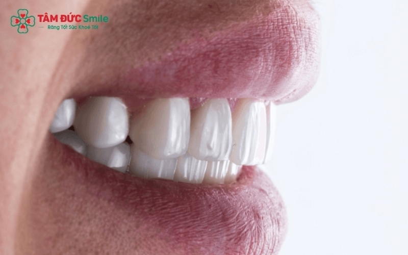 Việc thăm khám trực tiếp để bác sĩ xác định liệu bọc răng sứ có thực sự cần thiết và mang lại hiệu quả bền vững hay không.