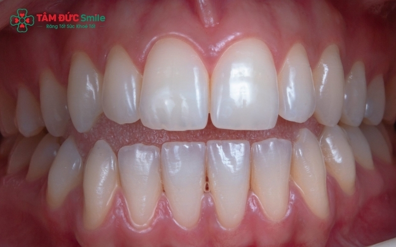 Dù răng sứ hiện đại có tính thẩm mỹ và độ chịu lực rất cao, nhưng mô răng thật vẫn luôn là cấu trúc sinh học quý giá nhất cần được ưu tiên bảo tồn.