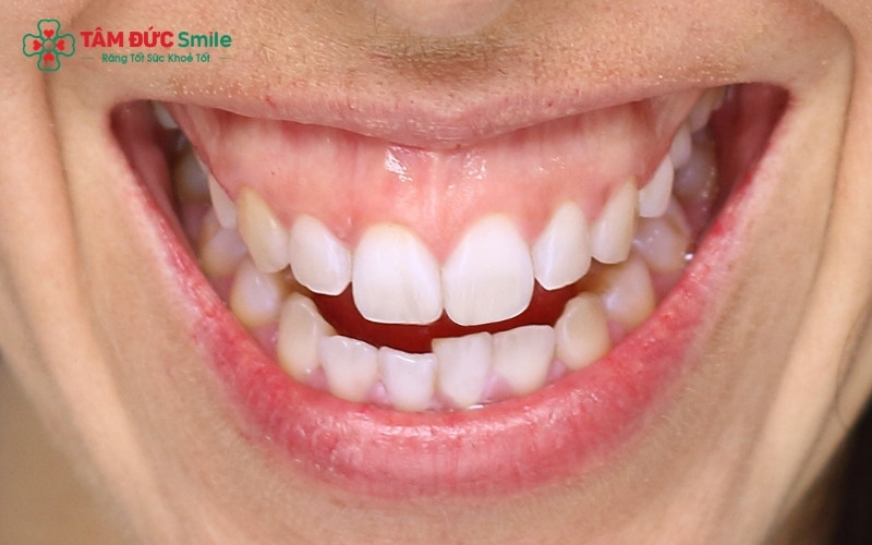 Cười hở lợi là tình trạng phần nướu lộ ra quá nhiều (thường trên 3mm) khi cười, gây mất cân đối giữa môi, răng và lợi.