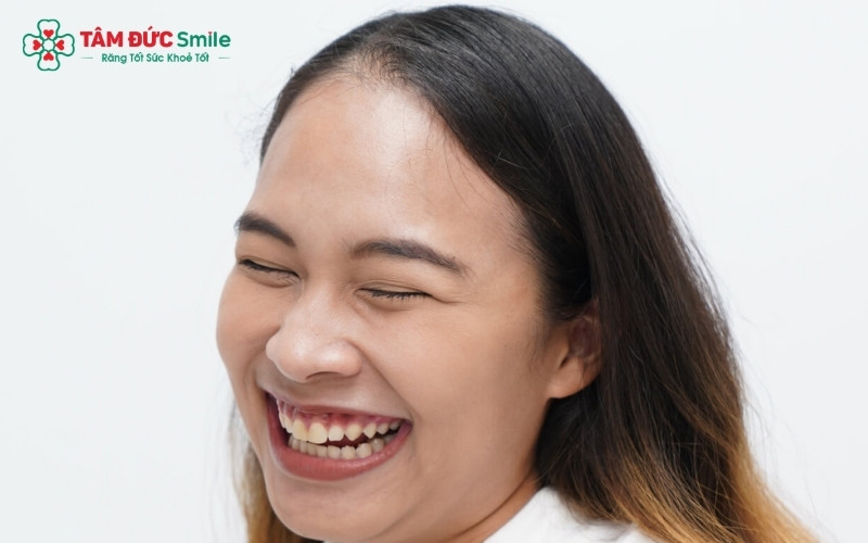 Có nhiều nguyên nhân dẫn đến cười hở lợi như cấu trúc xương hàm, cơ nâng môi hoạt động mạnh hoặc do mô nướu phát triển quá mức.