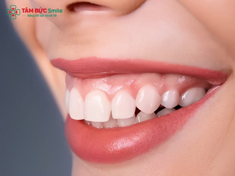 Cười hở lợi là gì? Nguyên nhân và cách khắc phục hiệu quả