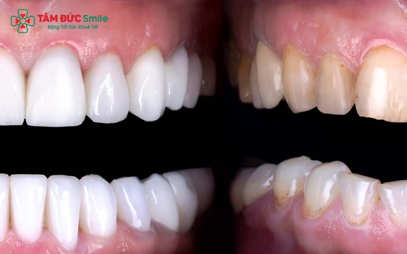 Những nhược điểm và lưu ý quan trọng cần biết trước khi quyết định dán răng sứ Veneer để tránh rủi ro không đáng có