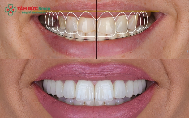 Ưu điểm vượt trội của dán sứ Veneer: giúp bảo tồn răng thật tối đa và mang lại vẻ đẹp tự nhiên cho nụ cười.