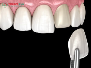 Dán răng sứ veneer có tốt không?