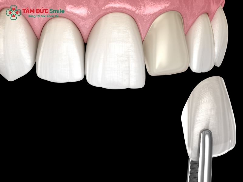 Dán răng sứ veneer có tốt không?
