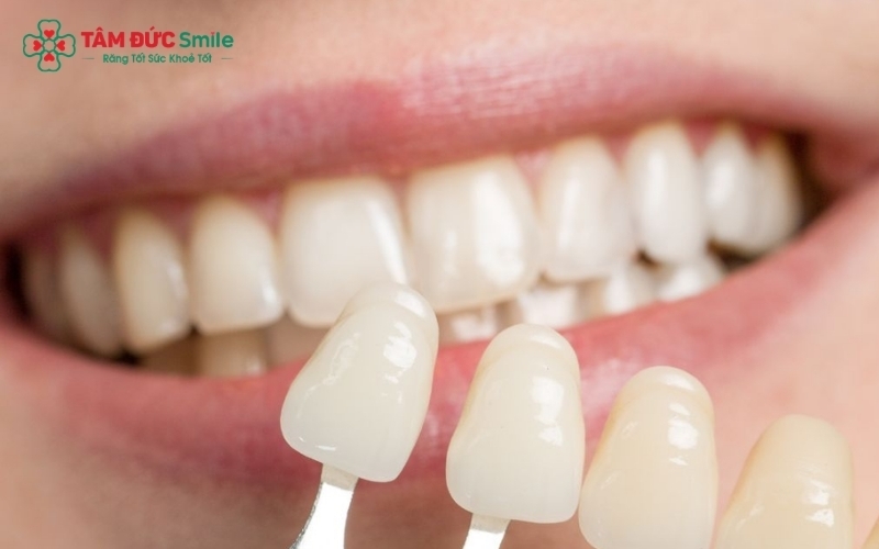 Ưu điểm vượt trội của dán sứ Veneer 2 răng cửa là khả năng bảo tồn răng thật tối đa, màu sắc tự nhiên và đạt độ thẩm mỹ cao nhất