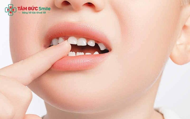 Độ tuổi thay răng sữa thường bắt đầu từ 6 tuổi và kéo dài đến năm 12 tuổi, đánh dấu giai đoạn phát triển quan trọng của bộ răng vĩnh viễn.