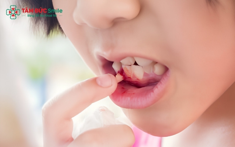 Răng sữa lung lay là dấu hiệu cho thấy chân răng đang tiêu dần để chuẩn bị nhường chỗ cho răng vĩnh viễn mọc lên.