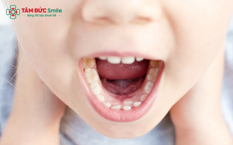 Tốc độ mọc răng vĩnh viễn phụ thuộc vào cơ địa của từng trẻ; cha mẹ cần theo dõi để đảm bảo răng mọc đúng vị trí trên cung hàm.