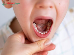 Độ tuổi thay răng sữa ở trẻ em
