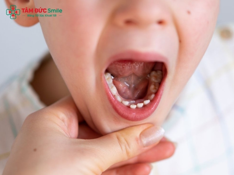 Độ tuổi thay răng sữa ở trẻ em