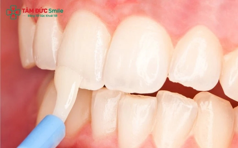 Fluoride giúp tái khoáng men răng, tạo lớp màng bảo vệ răng khỏi sự tấn công của axit từ vi khuẩn và thực phẩm.