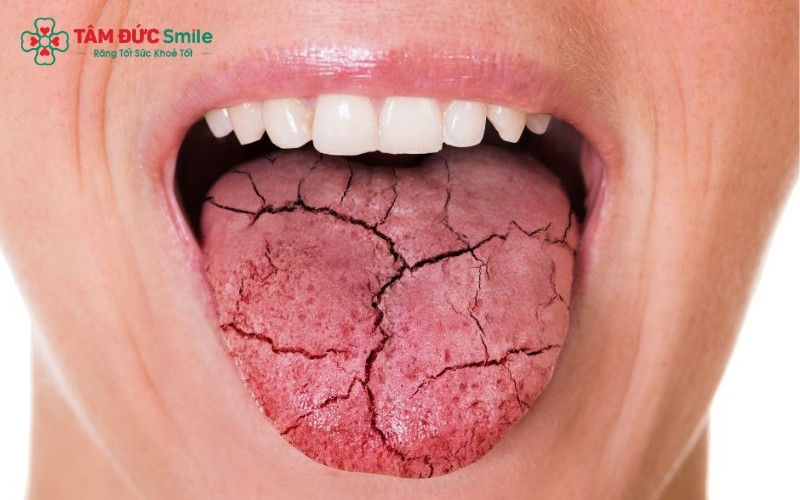 Các triệu chứng điển hình của khô miệng bao gồm cảm giác dính trong khoang miệng, môi khô nứt nẻ và lưỡi khô ráp gây khó khăn khi ăn nhai.