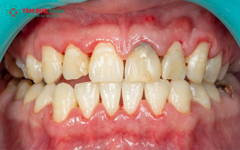 Thiếu nước bọt làm mất đi "hàng rào" bảo vệ tự nhiên, khiến vi khuẩn dễ dàng tấn công gây sâu răng, viêm nướu và hôi miệng kéo dài.