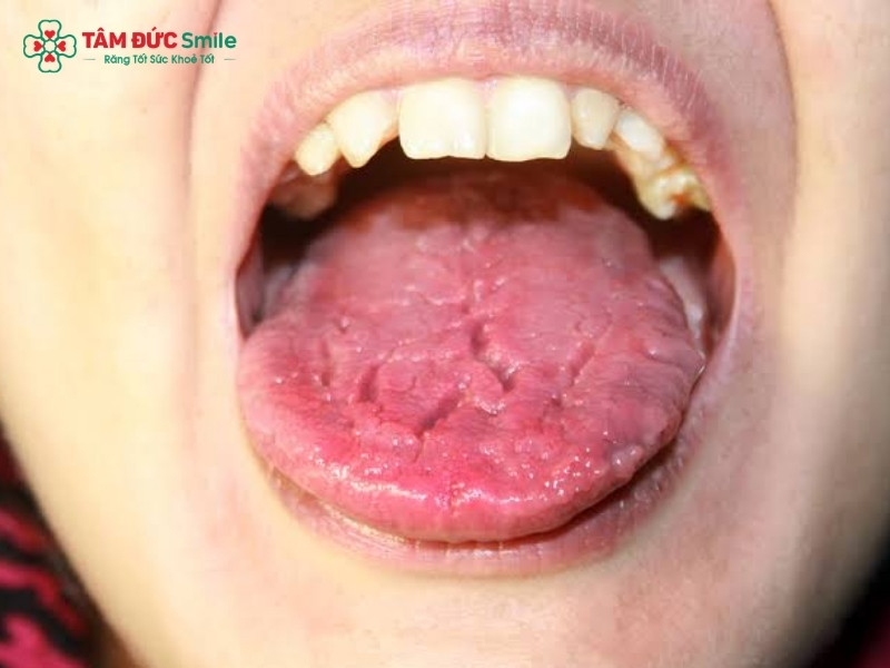 Khô miệng: Nguyên nhân, triệu chứng và cách phòng ngừa