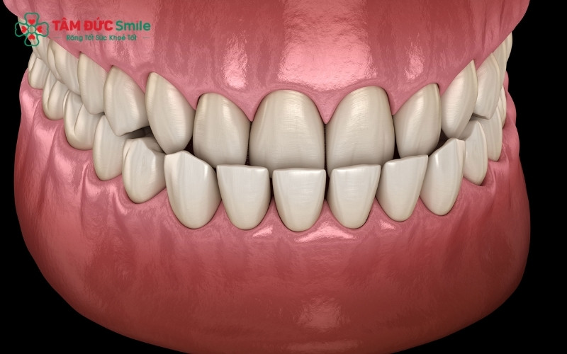 Hình ảnh cận cảnh khớp cắn ngược: Răng hàm dưới đưa ra trước và bao phủ răng hàm trên, gây ra tình trạng móm và sai lệch khớp cắn.