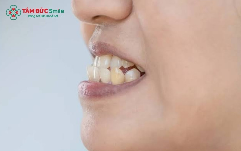 Khớp cắn ngược khiến tương quan môi - cằm mất cân đối, tạo cảm giác khuôn mặt bị gãy hoặc lõm khi nhìn từ góc nghiêng.