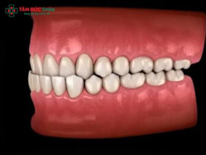 Khớp cắn ngược là gì? Khớp cắn ngược điều trị như thế nào?