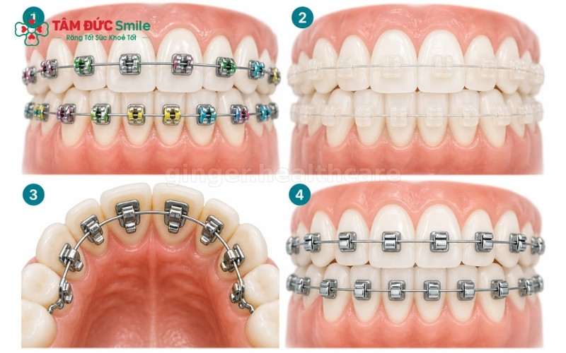  Tùy vào nhu cầu thẩm mỹ và tình trạng răng, khách hàng tại Tâm Đức Smile có thể lựa chọn giữa mắc cài kim loại bền bỉ hoặc mắc cài sứ thẩm mỹ.