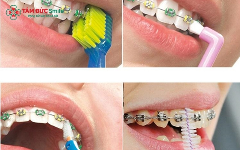 Sử dụng các dụng cụ hỗ trợ như bàn chải kẽ và máy tăm nước giúp làm sạch hoàn toàn mảng bám quanh mắc cài, ngăn ngừa sâu răng khi niềng.