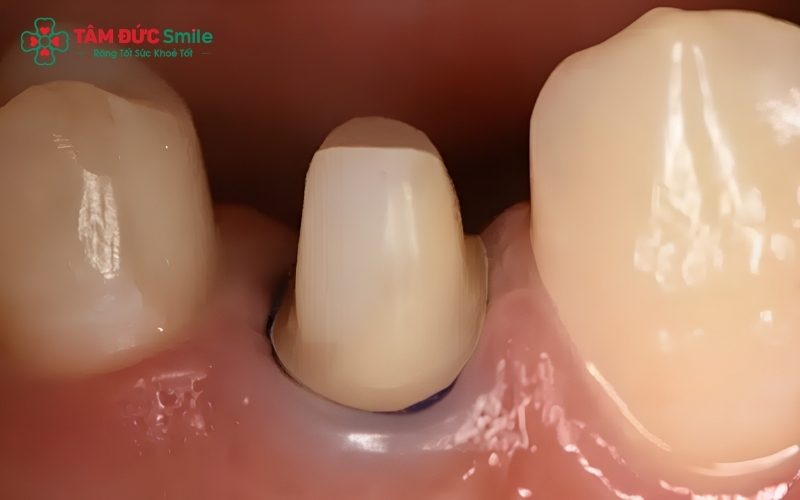 Việc mài răng quá mức hoặc mão sứ không sát khít là nguyên nhân chính dẫn đến tình trạng viêm nướu, ê buốt kéo dài và tổn thương tủy răng về lâu dài