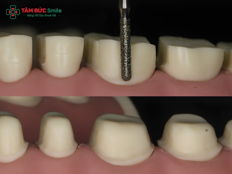 Mài răng bọc sứ có ảnh hưởng không? Tác hại và lưu ý cần biết