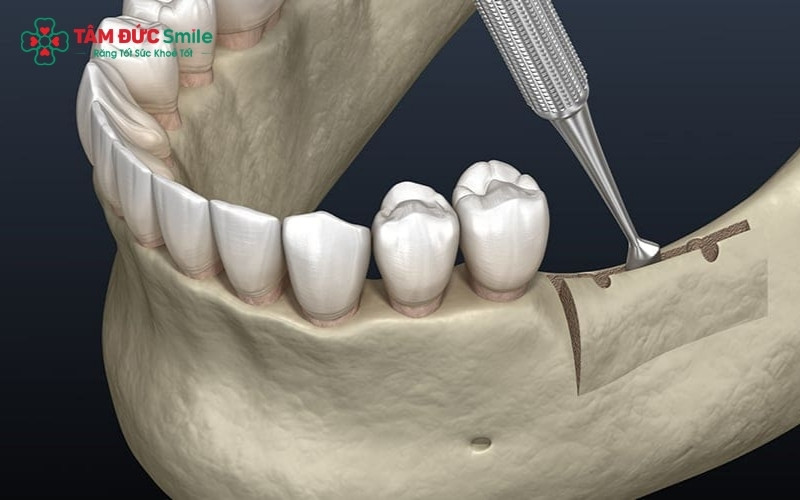 Kỹ thuật mài xương giúp tái tạo đường viền nướu, cải thiện thẩm mỹ nụ cười và giảm độ nhô của khuôn miệng một cách hiệu quả.