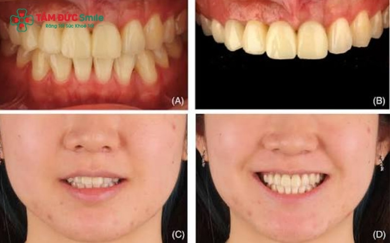 Tình trạng cười hở lợi hoặc hô do xương ổ răng là những trường hợp điển hình cần thực hiện mài gồ xương để lấy lại sự cân đối.