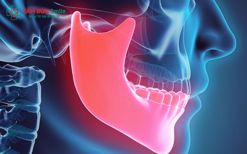 Xương ổ răng là phần xương bao bọc chân răng; khi phần xương này phát triển quá mức sẽ gây ra tình trạng gồ hoặc hô, cần được can thiệp điều chỉnh.