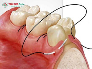 Mài gồ xương ổ răng là gì? Khi nào cần thực hiện?
