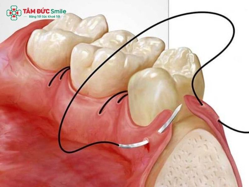 Mài gồ xương ổ răng là gì? Khi nào cần thực hiện?