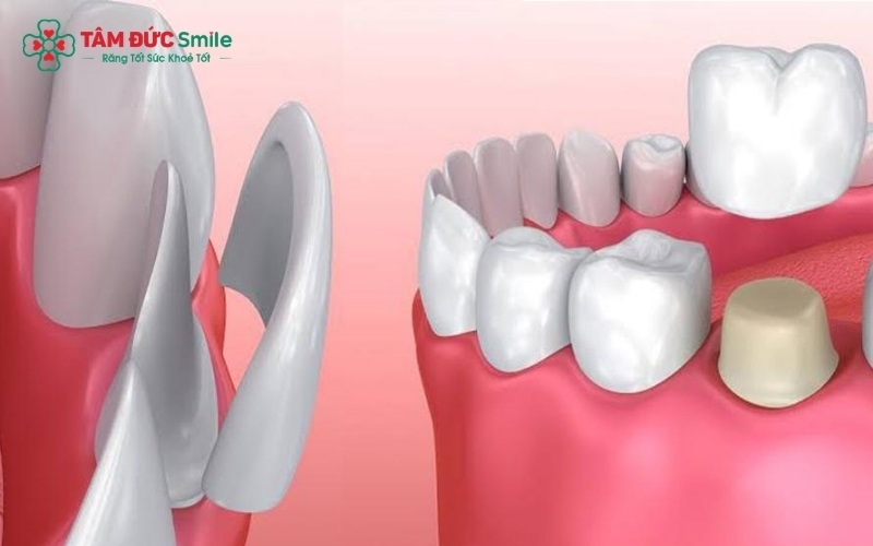 Veneer (trái) tập trung vào thẩm mỹ và bảo tồn men răng tối đa, trong khi bọc răng sứ (phải) phục hồi toàn diện hình thể và khả năng chịu lực cho những răng đã tổn thương.