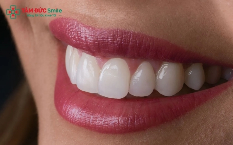Dù lựa chọn Veneer hay bọc sứ, mục tiêu cuối cùng vẫn là tạo ra nụ cười hài hòa, màu sắc tự nhiên và khớp cắn chuẩn xác cho khách hàng.